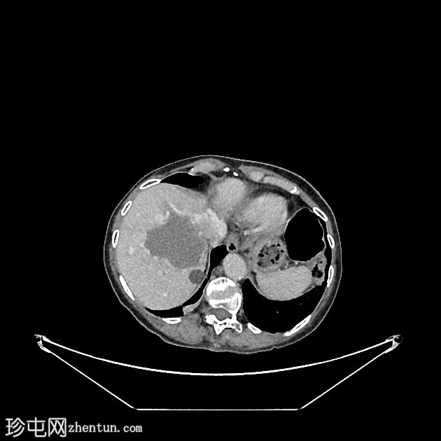 脊椎浆细胞瘤、巨大肝血管瘤