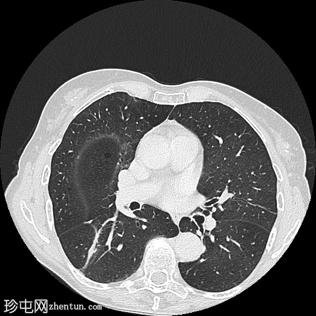 脊椎浆细胞瘤、巨大肝血管瘤