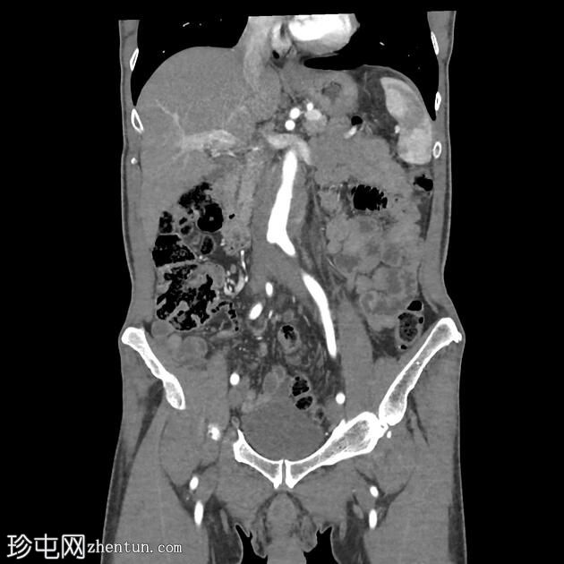 腹膜后纤维化