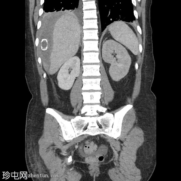 胆结石掉落