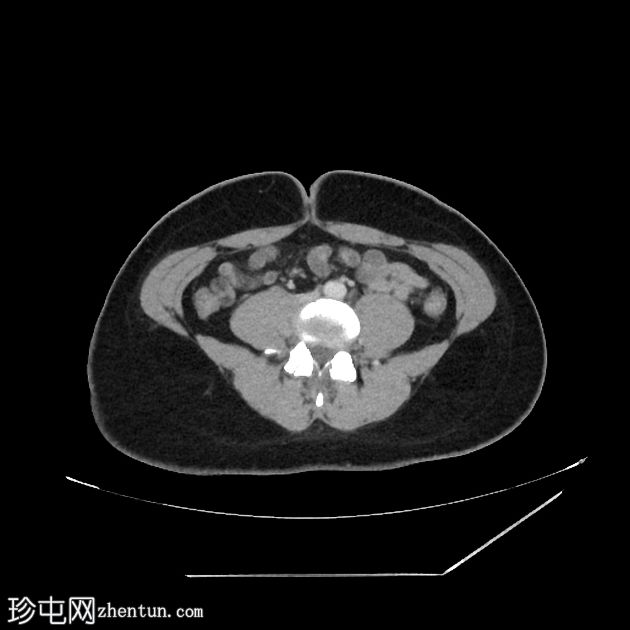 胰腺实性假乳头状瘤