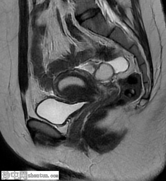 MRI 上的短暂性生理性子宫收缩