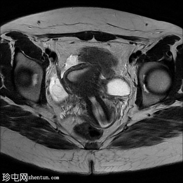 MRI 上的短暂性生理性子宫收缩