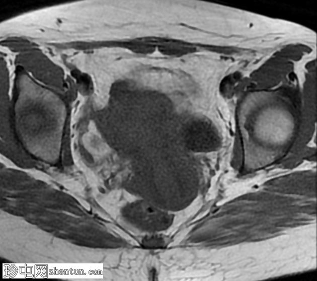 MRI 上的短暂性生理性子宫收缩