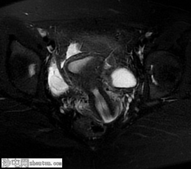 MRI 上的短暂性生理性子宫收缩