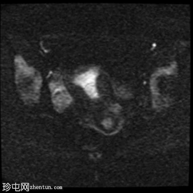 MRI 上的短暂性生理性子宫收缩