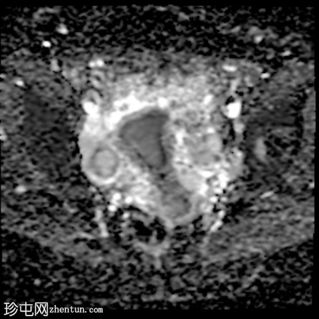 MRI 上的短暂性生理性子宫收缩