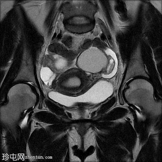 MRI 上的短暂性生理性子宫收缩