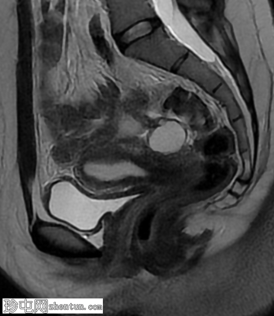 MRI 上的短暂性生理性子宫收缩