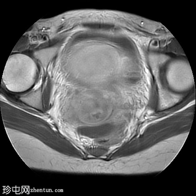 粘膜下子宫肌瘤