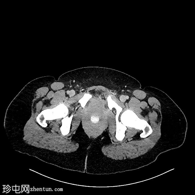 子宫放线菌病