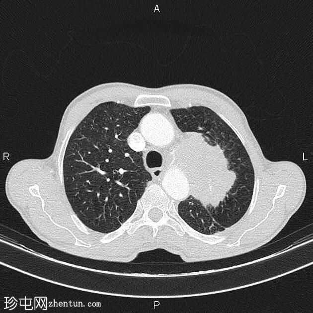 肺鳞状细胞癌