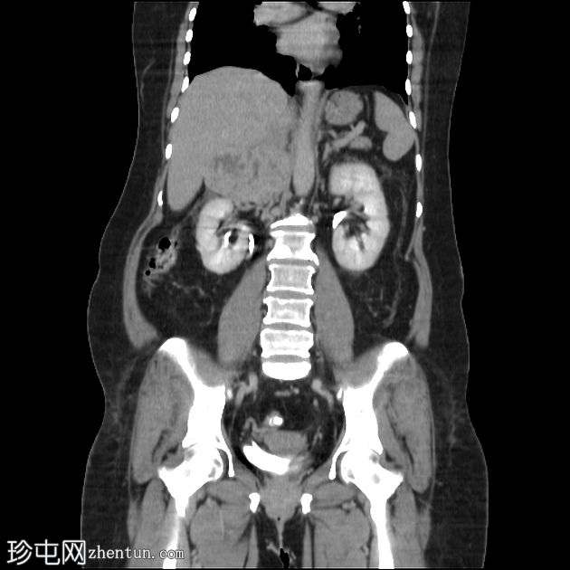 下腔静脉平滑肌肉瘤