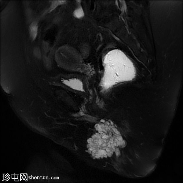 源自肛周瘘的肛周黏液腺癌