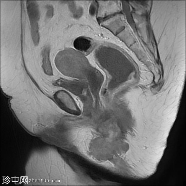 源自肛周瘘的肛周黏液腺癌