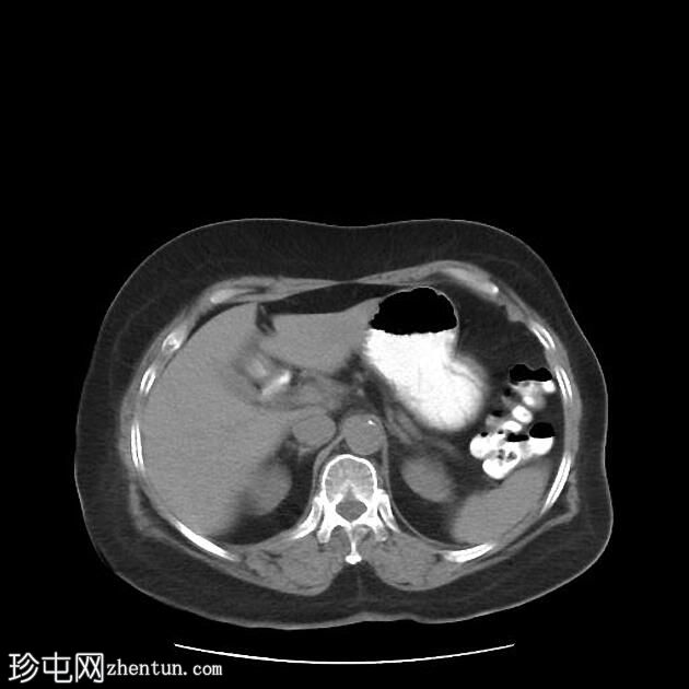 背胰腺发育不全