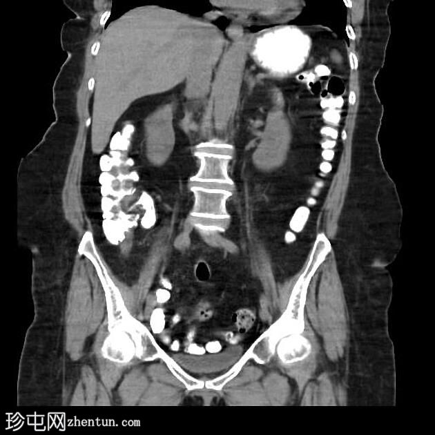 背胰腺发育不全