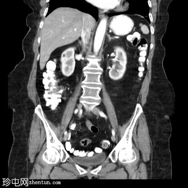 背胰腺发育不全