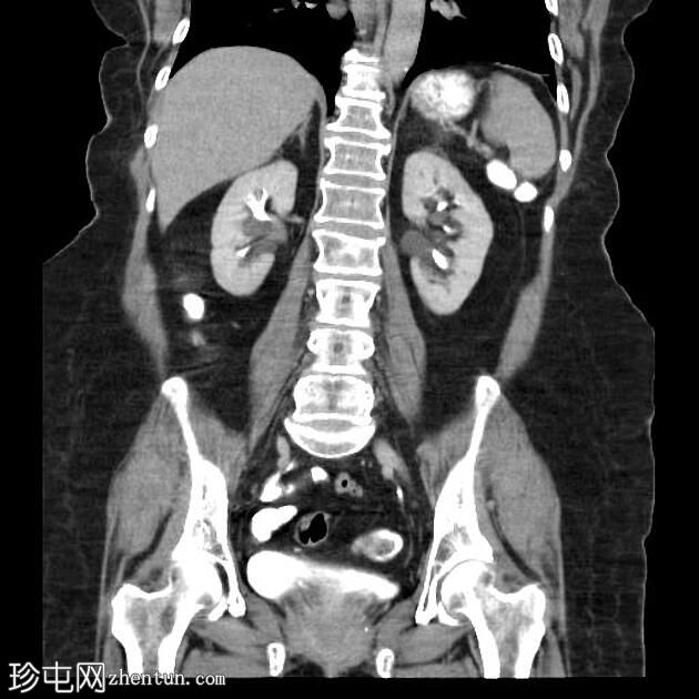 背胰腺发育不全