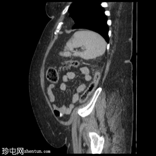 非闭塞性缺血性结肠炎