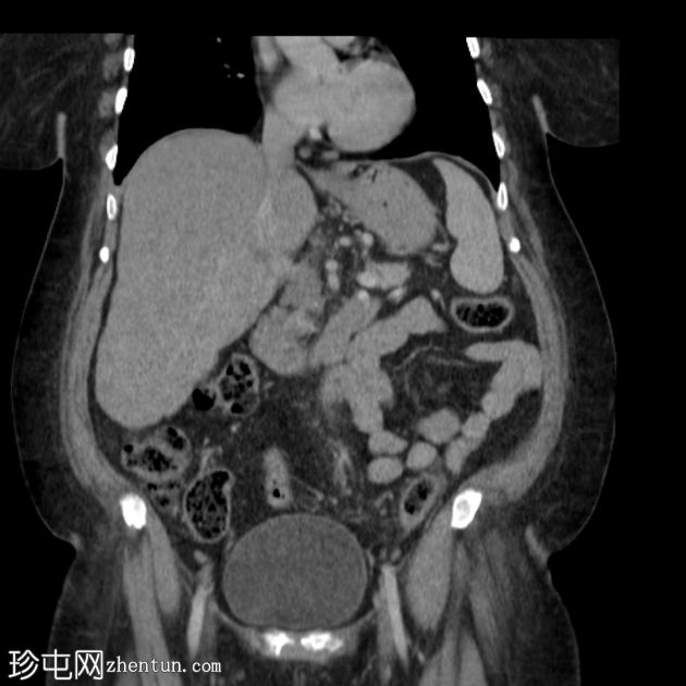 非闭塞性缺血性结肠炎