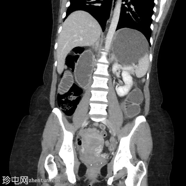 胃束带手术并发症导致急性小肠梗阻