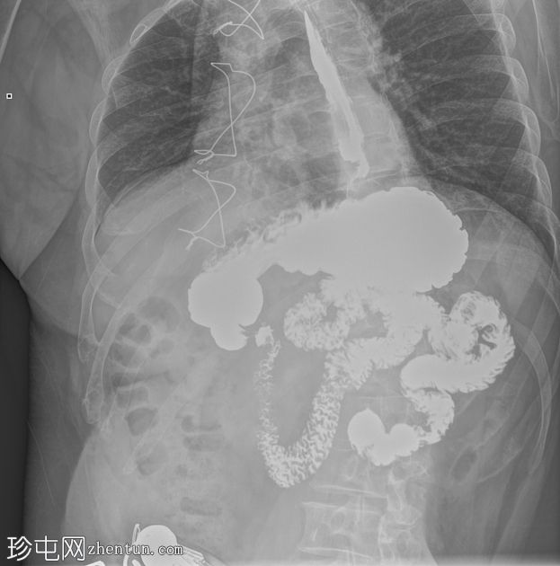 钡餐检查显示胃食管反流病和食管裂孔疝