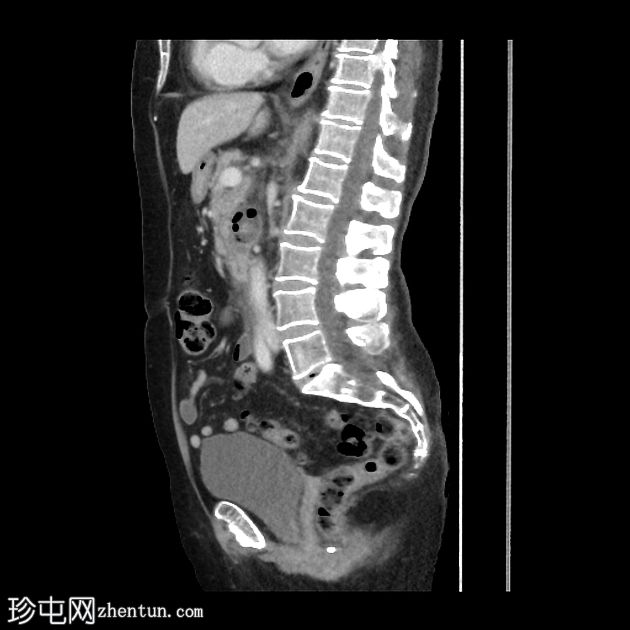 类似胰腺炎的急性十二指肠憩室炎