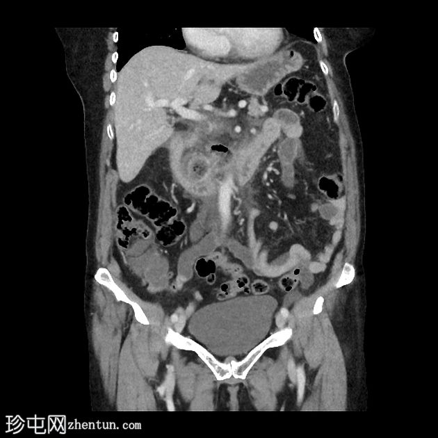 类似胰腺炎的急性十二指肠憩室炎