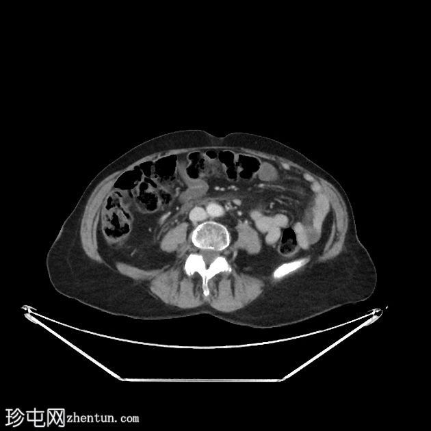 类似胰腺炎的急性十二指肠憩室炎