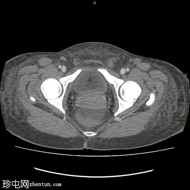 系统性红斑狼疮-胸部和胃肠道表现