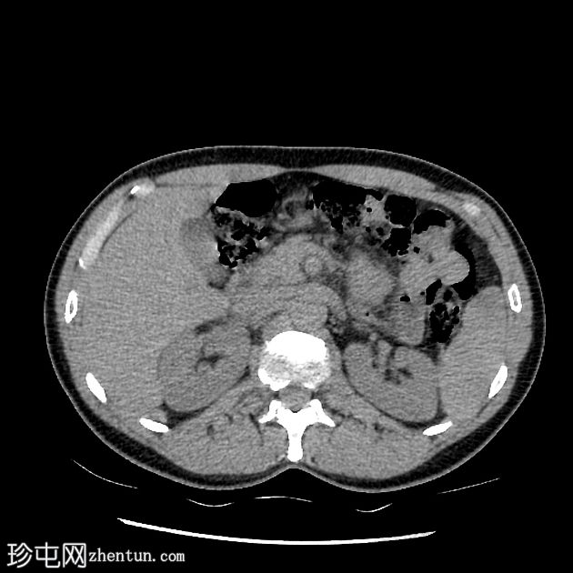 类似胰腺肿块的脾动脉假性动脉瘤