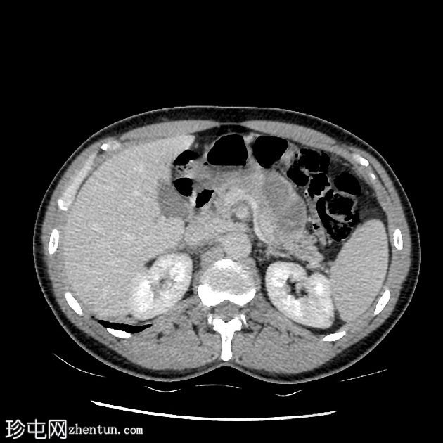 类似胰腺肿块的脾动脉假性动脉瘤