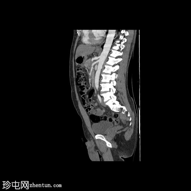 类似胰腺肿块的脾动脉假性动脉瘤