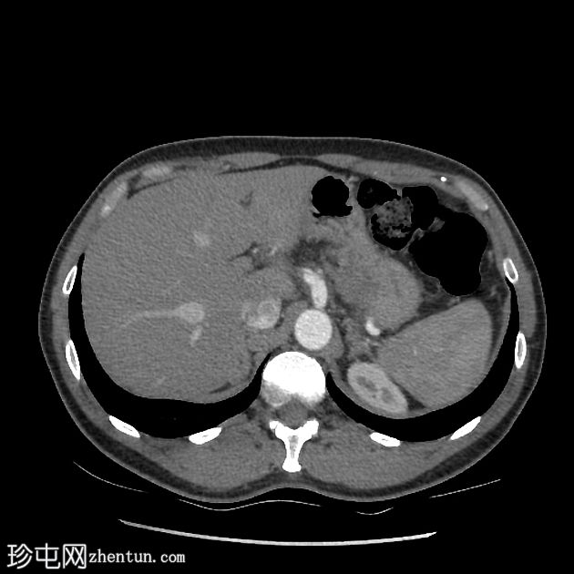 类似胰腺肿块的脾动脉假性动脉瘤