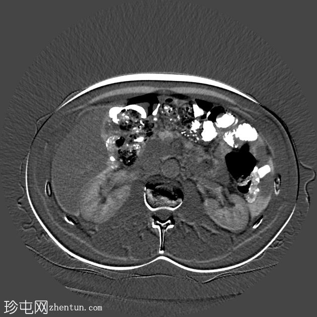 类似胰腺肿块的脾动脉假性动脉瘤