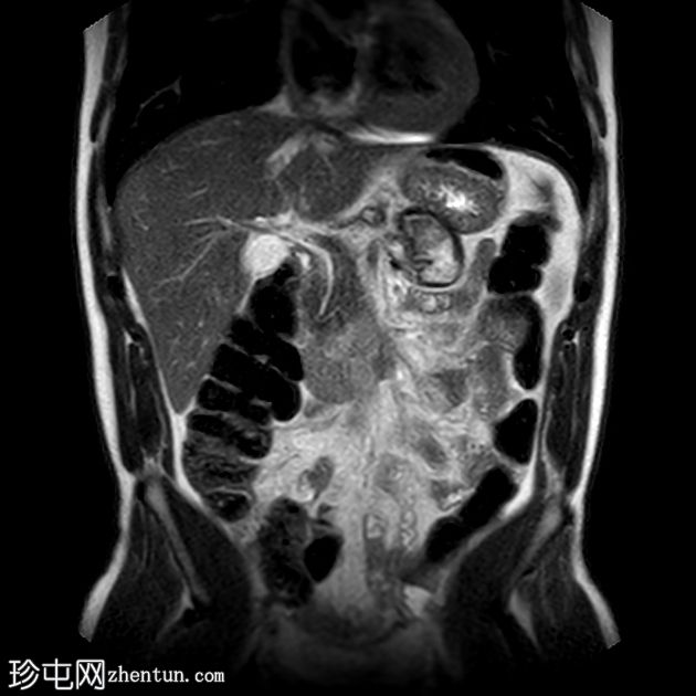 类似胰腺肿块的脾动脉假性动脉瘤