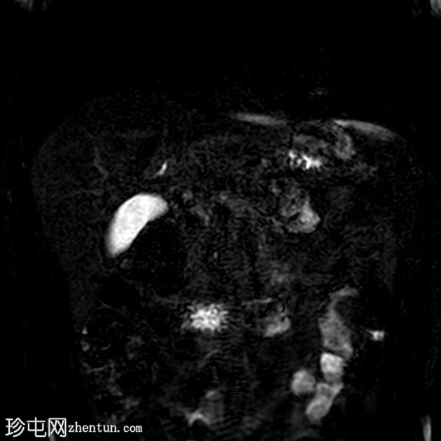 类似胰腺肿块的脾动脉假性动脉瘤