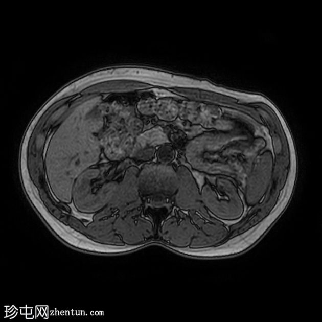 类似胰腺肿块的脾动脉假性动脉瘤