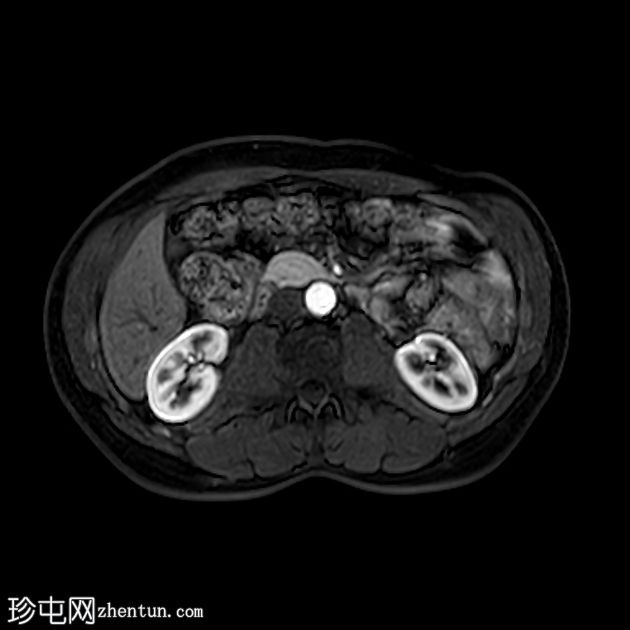 类似胰腺肿块的脾动脉假性动脉瘤