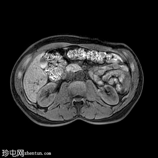 类似胰腺肿块的脾动脉假性动脉瘤