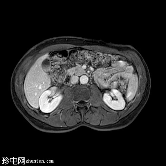 类似胰腺肿块的脾动脉假性动脉瘤