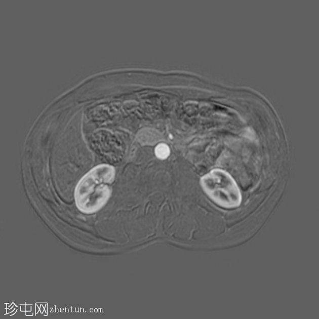 类似胰腺肿块的脾动脉假性动脉瘤