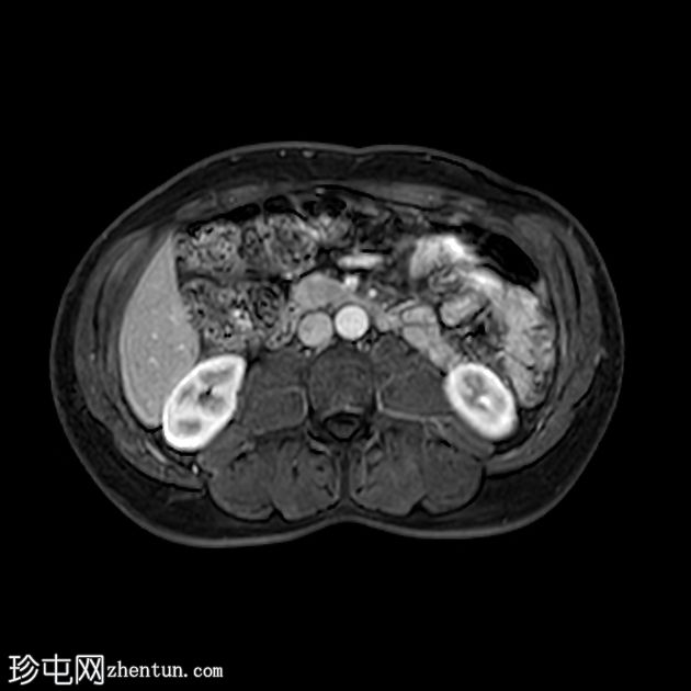 类似胰腺肿块的脾动脉假性动脉瘤