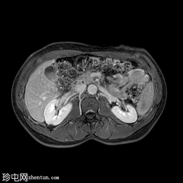 类似胰腺肿块的脾动脉假性动脉瘤