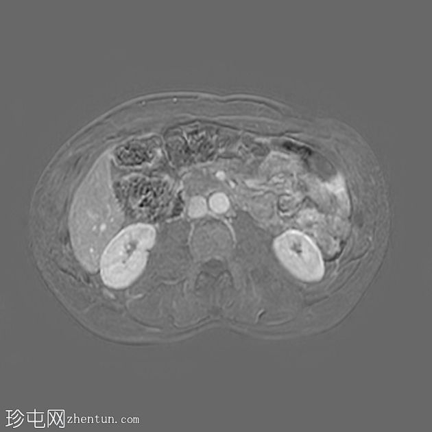 类似胰腺肿块的脾动脉假性动脉瘤