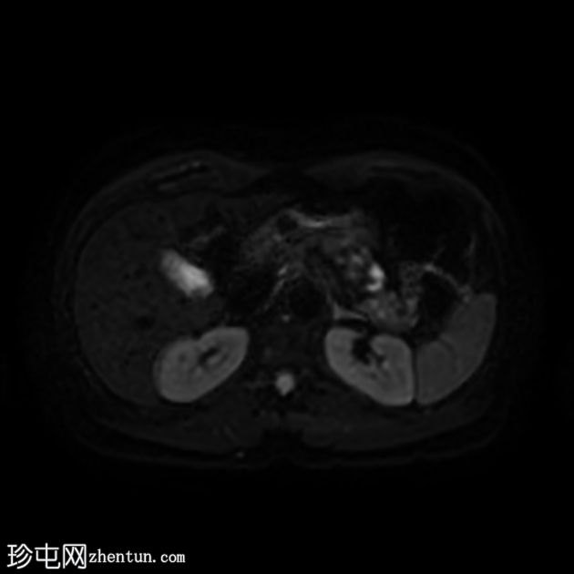 类似胰腺肿块的脾动脉假性动脉瘤