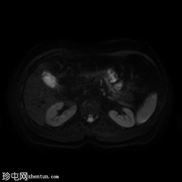 类似胰腺肿块的脾动脉假性动脉瘤