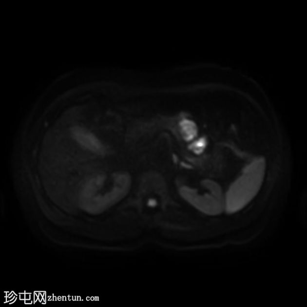 类似胰腺肿块的脾动脉假性动脉瘤