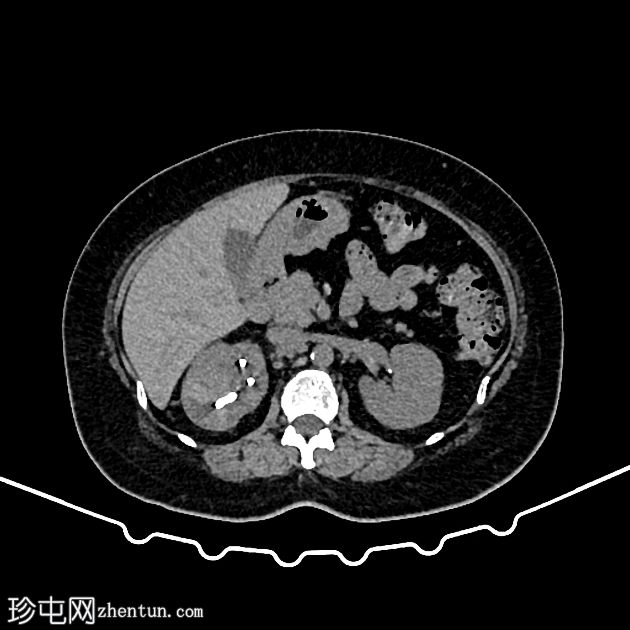 双J支架穿入肾实质